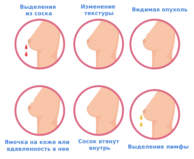 Профессор-онколог назвала первые признаки рака молочной железы: что важно знать женщинам